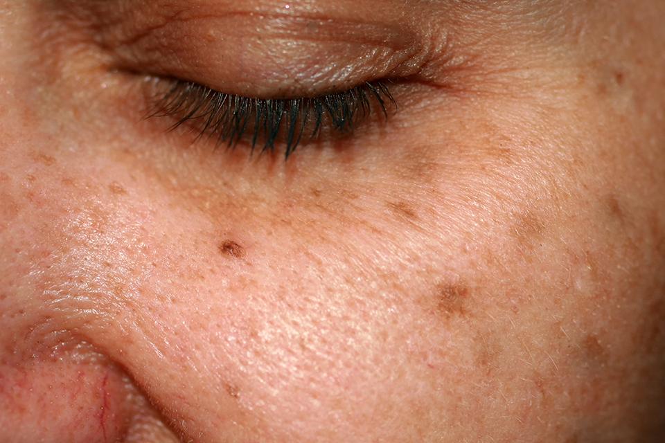 How to treat uneven skin tones.